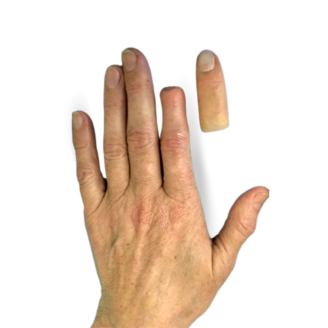Протезы пальцев рук в Москве - бесплатное протезирование пальцев руки | «СалютОрто»